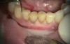 Immediate Provisional Bridge On Implants