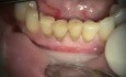 Immediate Provisional Bridge On Implants
