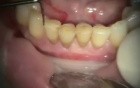 Immediate Provisional Bridge On Implants