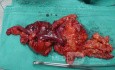 Severe case of Ischemic Colitis (13 of 19)