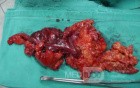 Severe case of Ischemic Colitis (13 of 19)