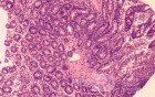 Duodenal Mucosa in Celiac Disease (6 of 6)