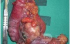 Caecal Tumor