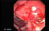 Adenocarcinoma of Papilla of Vater (3 of 5)
