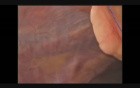 Laparoscopic recurrent umbilical hernia repair R. Tushev M. D.