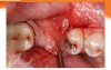 Ridge Augmentation With Mineross