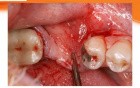 Ridge Augmentation With Mineross