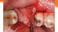 Ridge Augmentation With Mineross