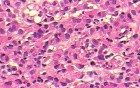 Small Gastric Adenocarcinoma of the Diffuse Ring Cell (5 of 19)