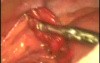 Injury Abdomen With Prolapse Of The Omentum And Intestinal Perforation
