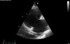 Free Tricuspid Insufficiency
