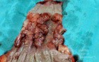 Barrett Adenocarcinoma - Endoscopic Image (18 of 20)