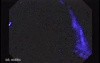 Sessile Tubulovillous Adenoma (3 of 13)