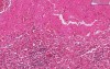 Amyloidosis - Histopathology - Spleen