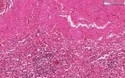 Amyloidosis - Histopathology - Spleen