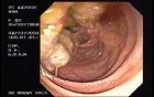 Submucosal Mass