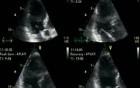 Dobutamine Stress Echocardiogram