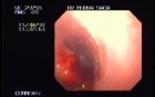 Squamous Cell Carcinoma of the Cardias (2 of 2 )