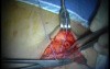 Autologous Bone Grafting (3/4)