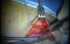 Autologous Bone Grafting (3/4)