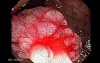 Giant Tubulo - Villous Adenoma (12 of 17)