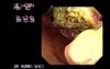 Gastric Adenocarcinoma - Obstruction - Endoscopy
