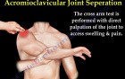 Shoulder Separation - Acromioclavicular Joint - Video Lecture