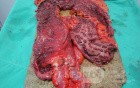 Multiple Rectal Ulcers (96 of 110)