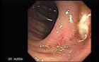 Diverticulitis (4 of 4)