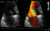Mitral Valve Perforation
