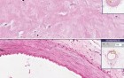 Atherosclerosis  recanalization - Histopathology - Coronary artery