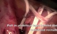 Laparoscopic rectopexy