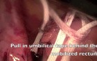 Laparoscopic rectopexy