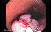 Huge Mass Of The Descending Colon (15 of 25)