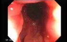 Adenocarcinoma and Hemorrhoids (2 of 2)