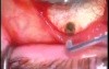 Glaucoma TCF, ABA Surgery with use Fugo Blade 
