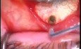 Glaucoma TCF, ABA Surgery with use Fugo Blade 
