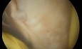 Hysteroscopic endometrial ablation and partial myometrectomy