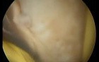 Hysteroscopic endometrial ablation and partial myometrectomy
