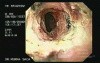 Zollinger- Ellison Syndrome - Gastric Ulcer with Gastrocolic Fistula (18 of 21)