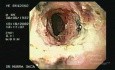 Zollinger- Ellison Syndrome - Gastric Ulcer with Gastrocolic Fistula (18 of 21)