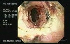 Zollinger- Ellison Syndrome - Gastric Ulcer with Gastrocolic Fistula (18 of 21)