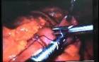 Jejunal Gastrointestinal Stromal tumor (GIST) (79 of 86)