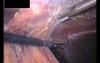 Adhesive Complications in a Patient After Ventral Hernia IPOM Repair - Case 1 