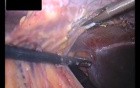 Adhesive Complications in a Patient After Ventral Hernia IPOM Repair - Case 1 