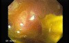 Rectum (24 of 30)