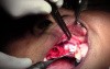 Maxillary Bone Grafting #7-8-10 Sites - Bone Grafting #10 Site