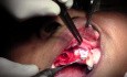 Maxillary Bone Grafting #7-8-10 Sites - Bone Grafting #10 Site