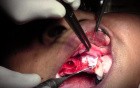 Maxillary Bone Grafting #7-8-10 Sites - Bone Grafting #10 Site