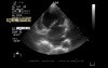 Myxomatous Mitral Valve with Mitral Valve Prolapse